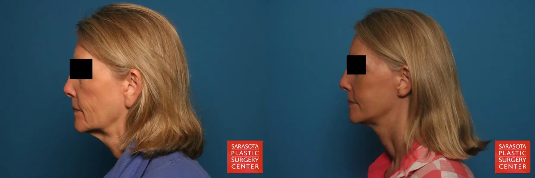 Mini Facelift: Patient 8 - Before and After 3