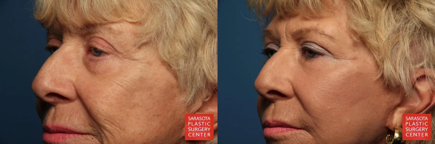 Fat Transfer - Face: Patient 7 - Before and After 2
