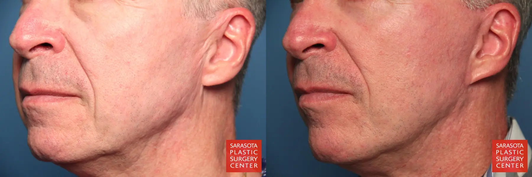 Fat Transfer   Face For Men: Patient 1 - Before and After 3