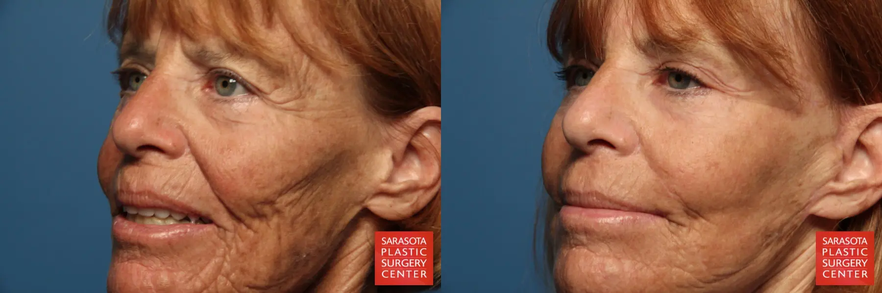 Fat Transfer - Face: Patient 10 - Before and After 2
