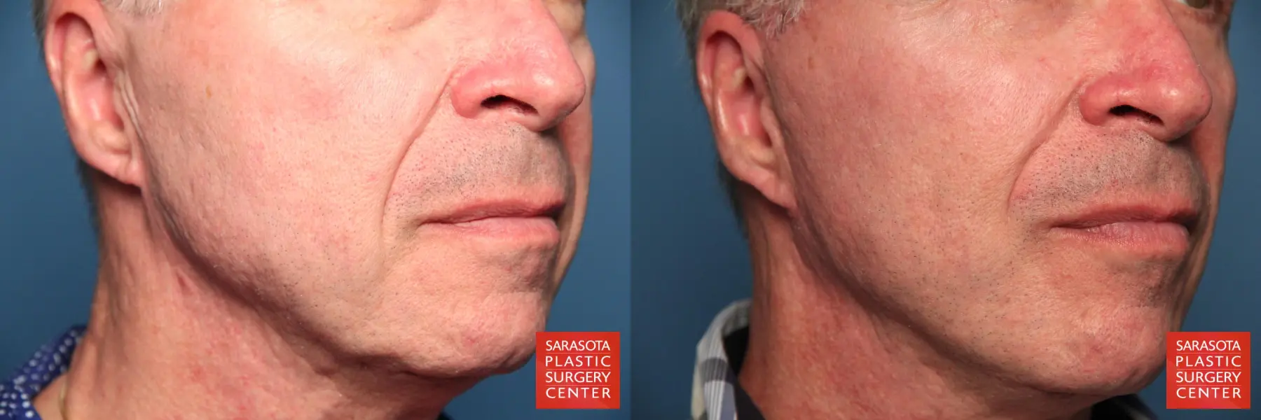 Fat Transfer   Face For Men: Patient 1 - Before and After 4