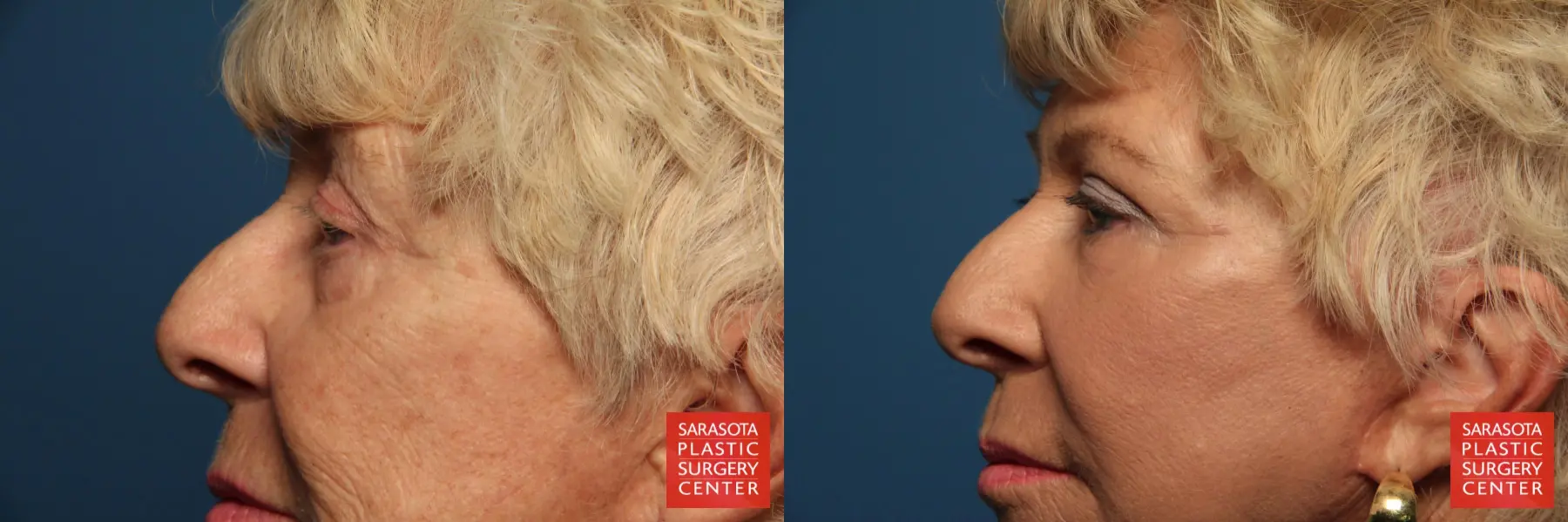 Fat Transfer - Face: Patient 7 - Before and After 3