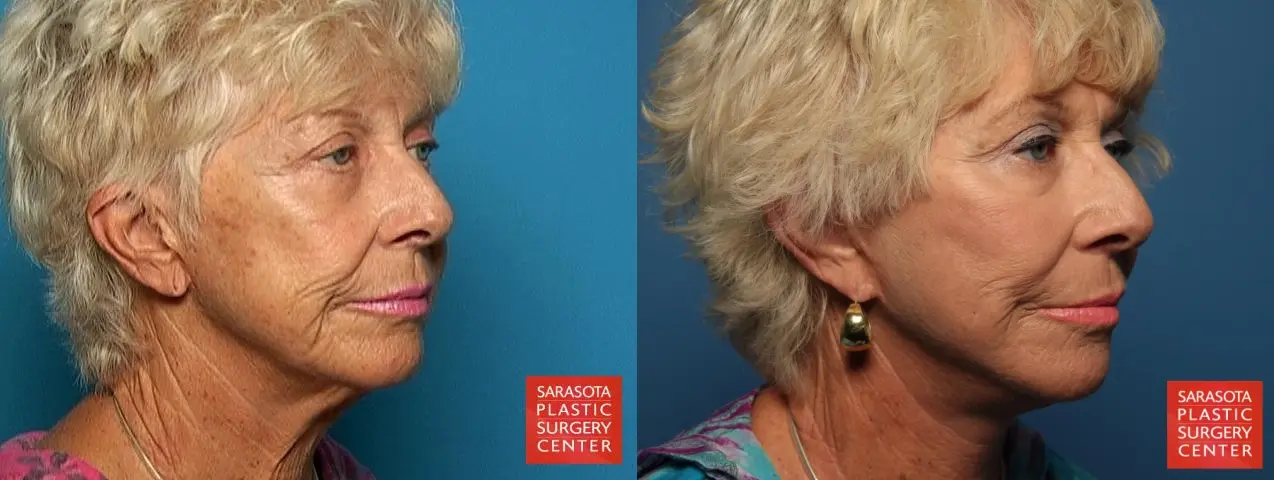 Fat Transfer - Face: Patient 3 - Before and After 4