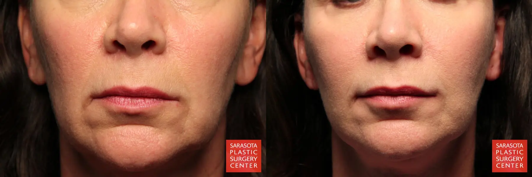 Fat Transfer - Face: Patient 11 - Before and After  