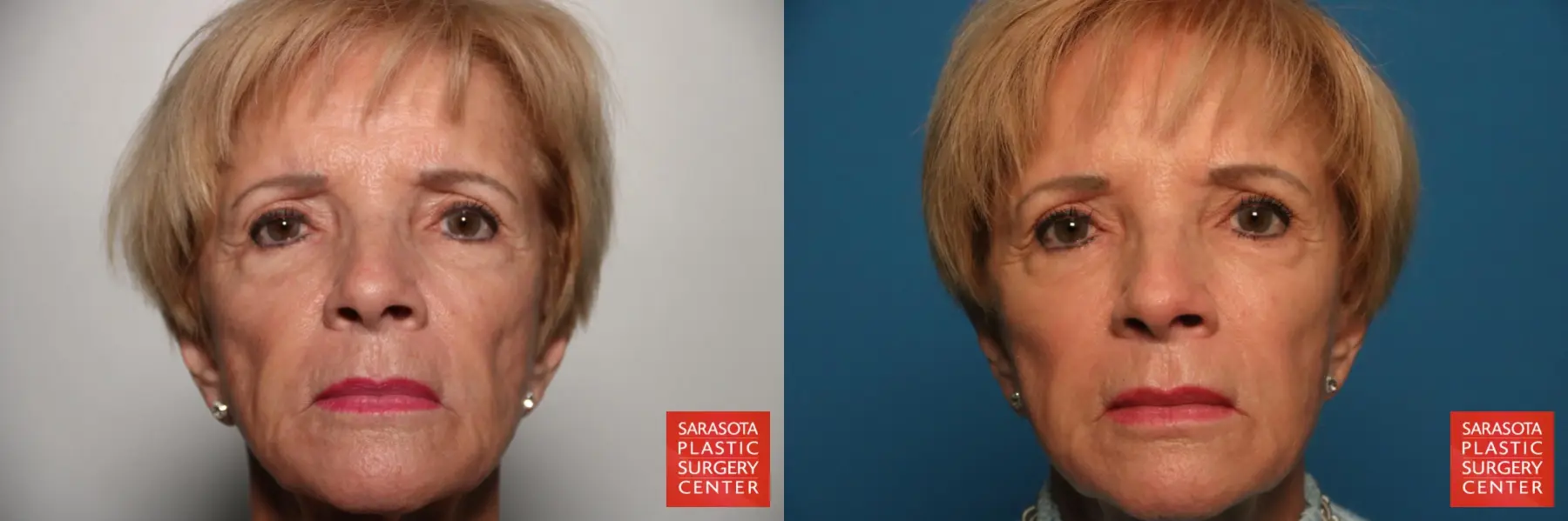 Fat Transfer - Face: Patient 12 - Before and After  