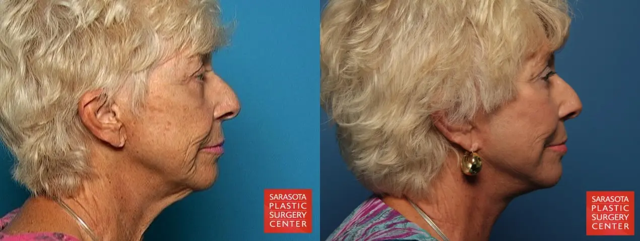 Fat Transfer - Face: Patient 3 - Before and After 5