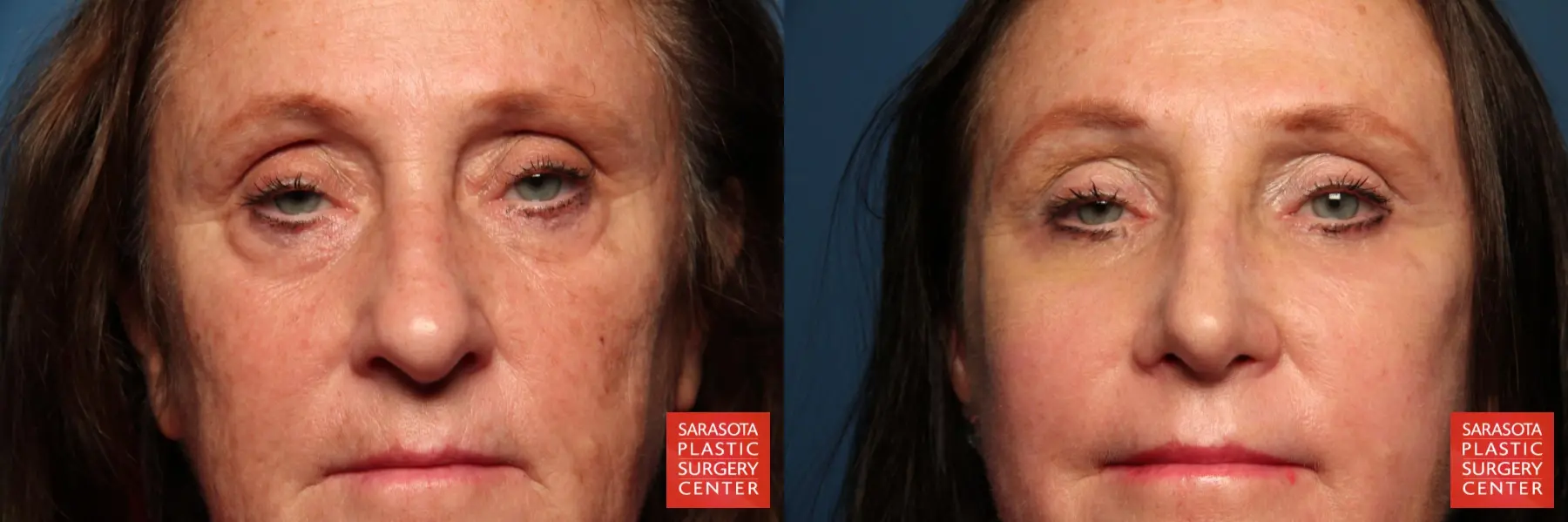 Fat Transfer - Face: Patient 4 - Before and After  