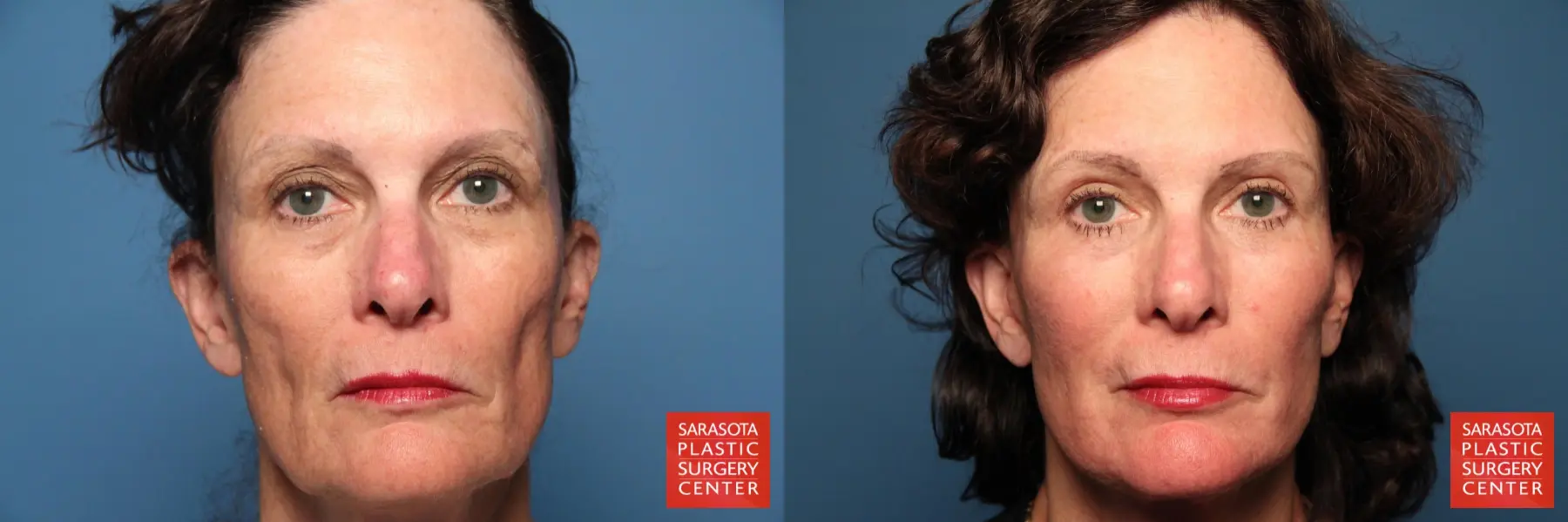 Fat Transfer - Face: Patient 5 - Before and After  