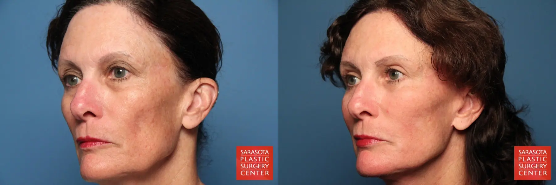 Fat Transfer - Face: Patient 5 - Before and After 3