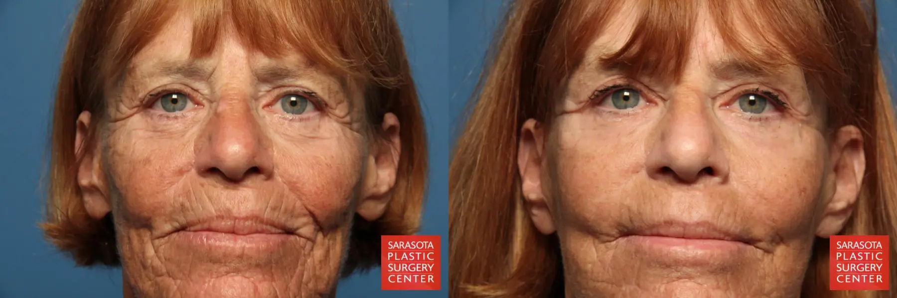 Fat Transfer - Face: Patient 10 - Before and After 1