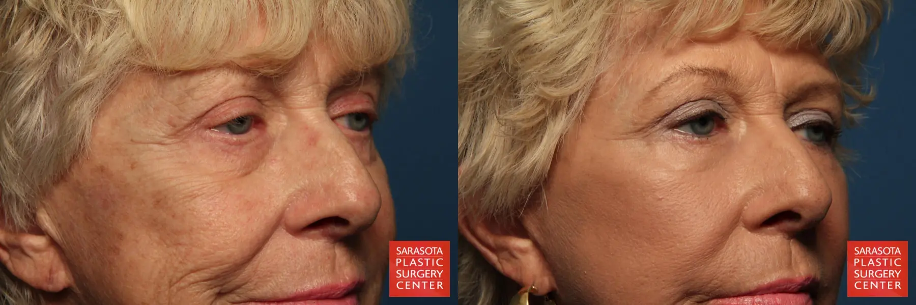 Fat Transfer - Face: Patient 7 - Before and After 4