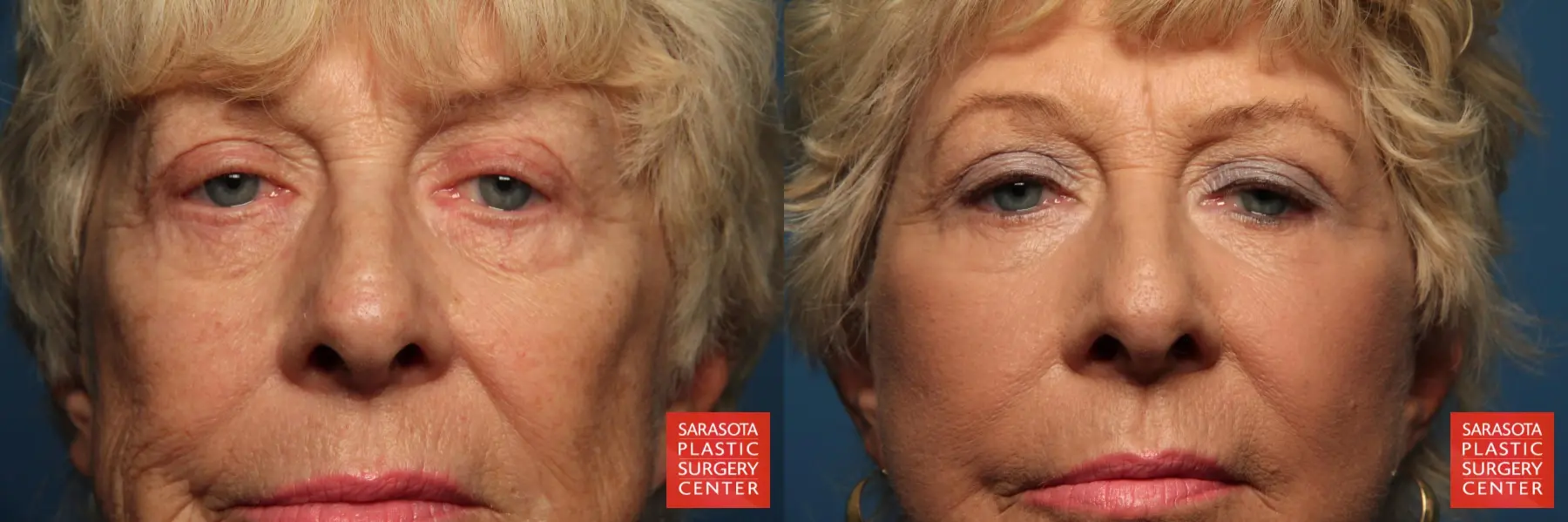 Fat Transfer - Face: Patient 7 - Before and After  