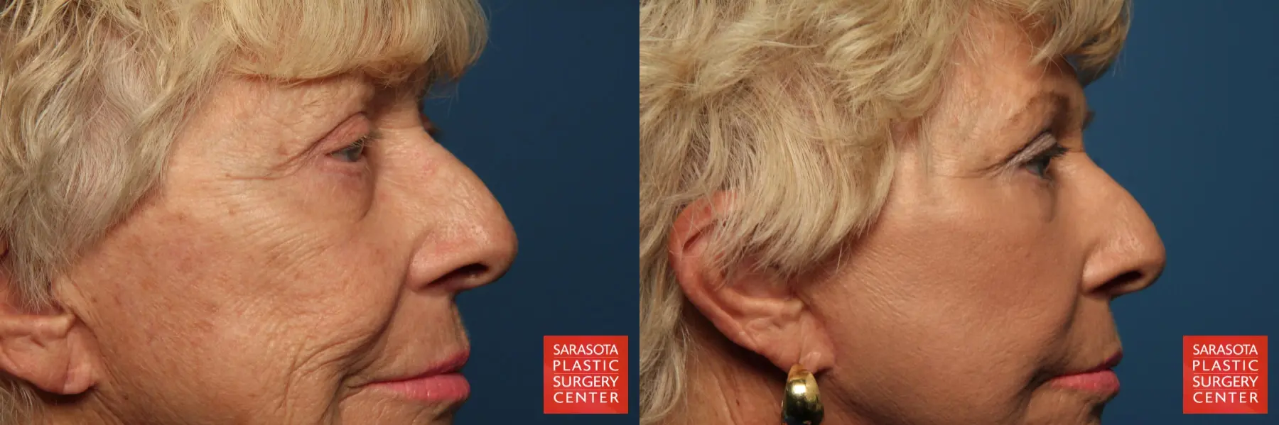 Fat Transfer - Face: Patient 7 - Before and After 5