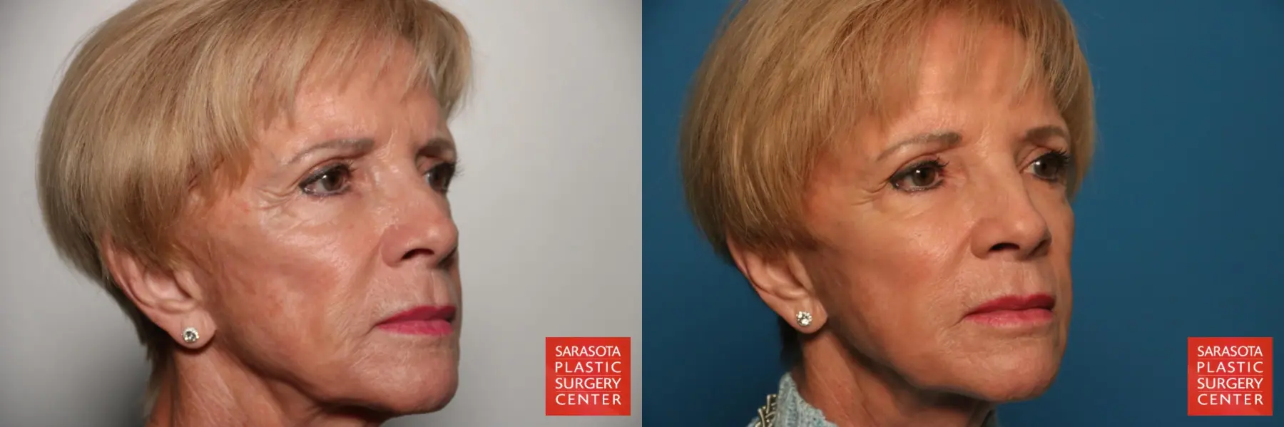 Fat Transfer - Face: Patient 12 - Before and After 2