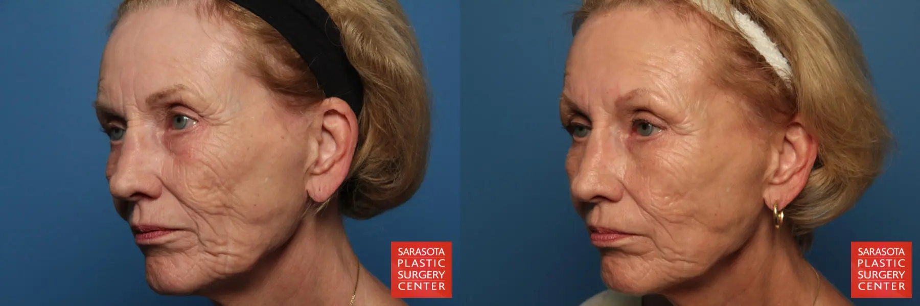 Fat Transfer - Face: Patient 8 - Before and After 2