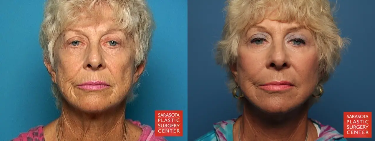 Fat Transfer - Face: Patient 3 - Before and After  