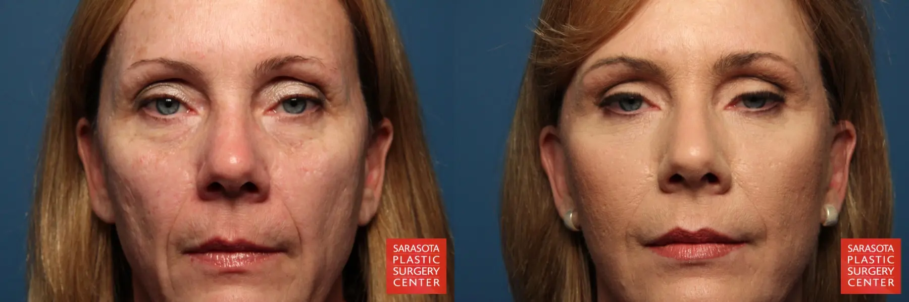 Fat Transfer - Face: Patient 1 - Before and After  