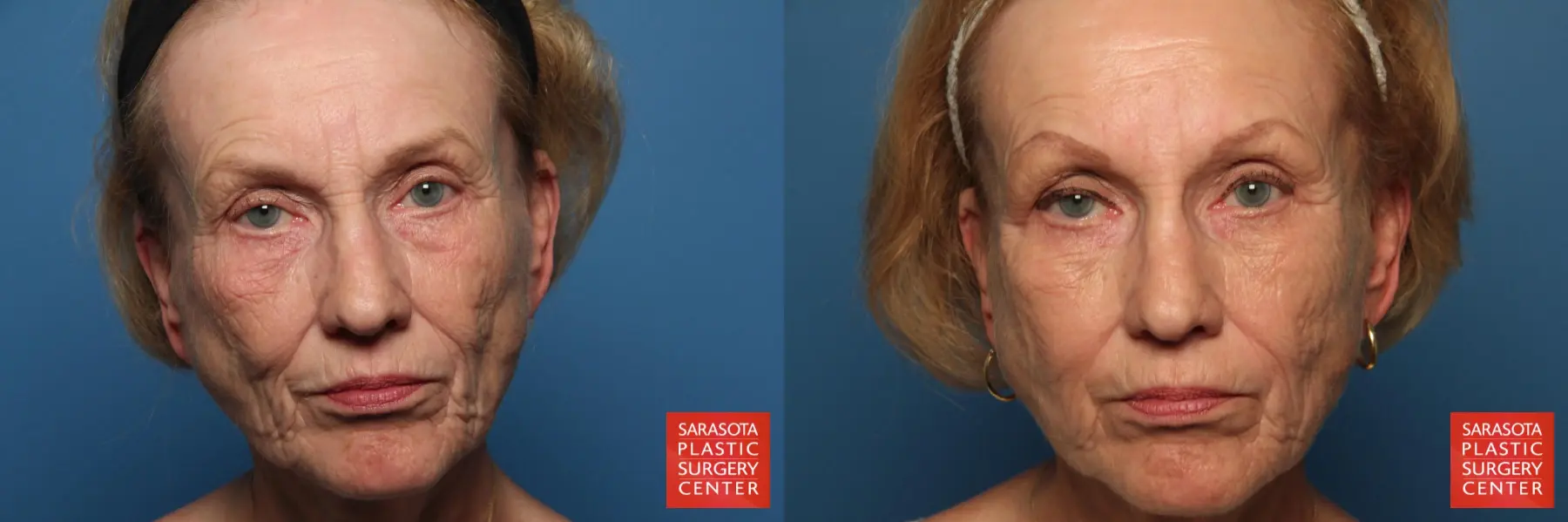 Fat Transfer - Face: Patient 8 - Before and After  