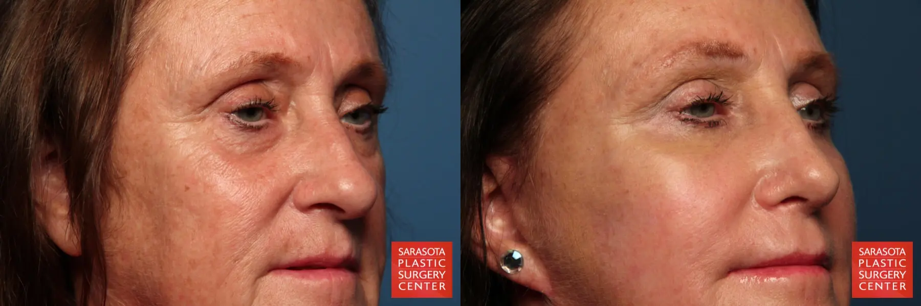 Fat Transfer - Face: Patient 4 - Before and After 2