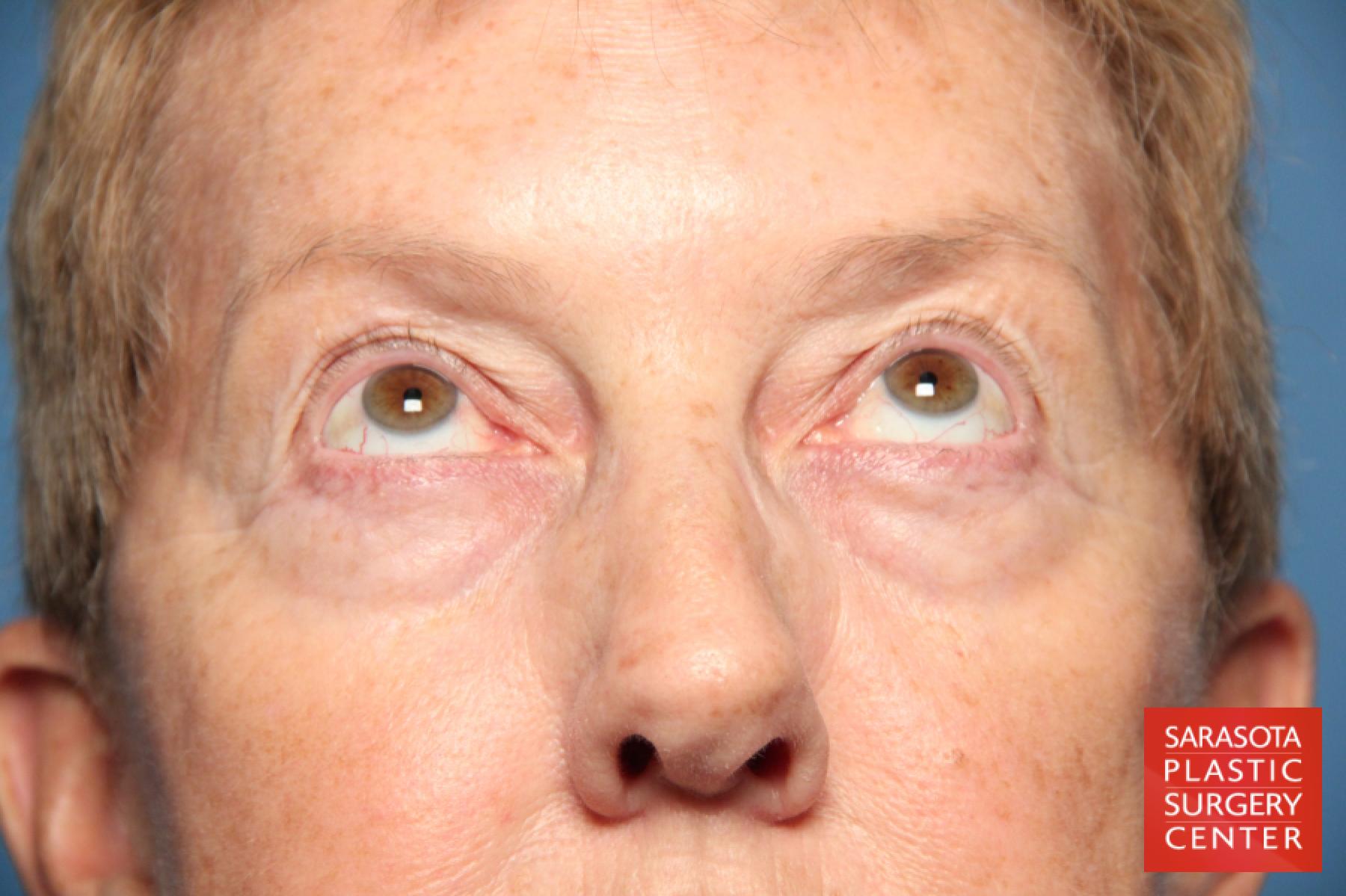 Eyelid Lift: Patient 22 - Before 3