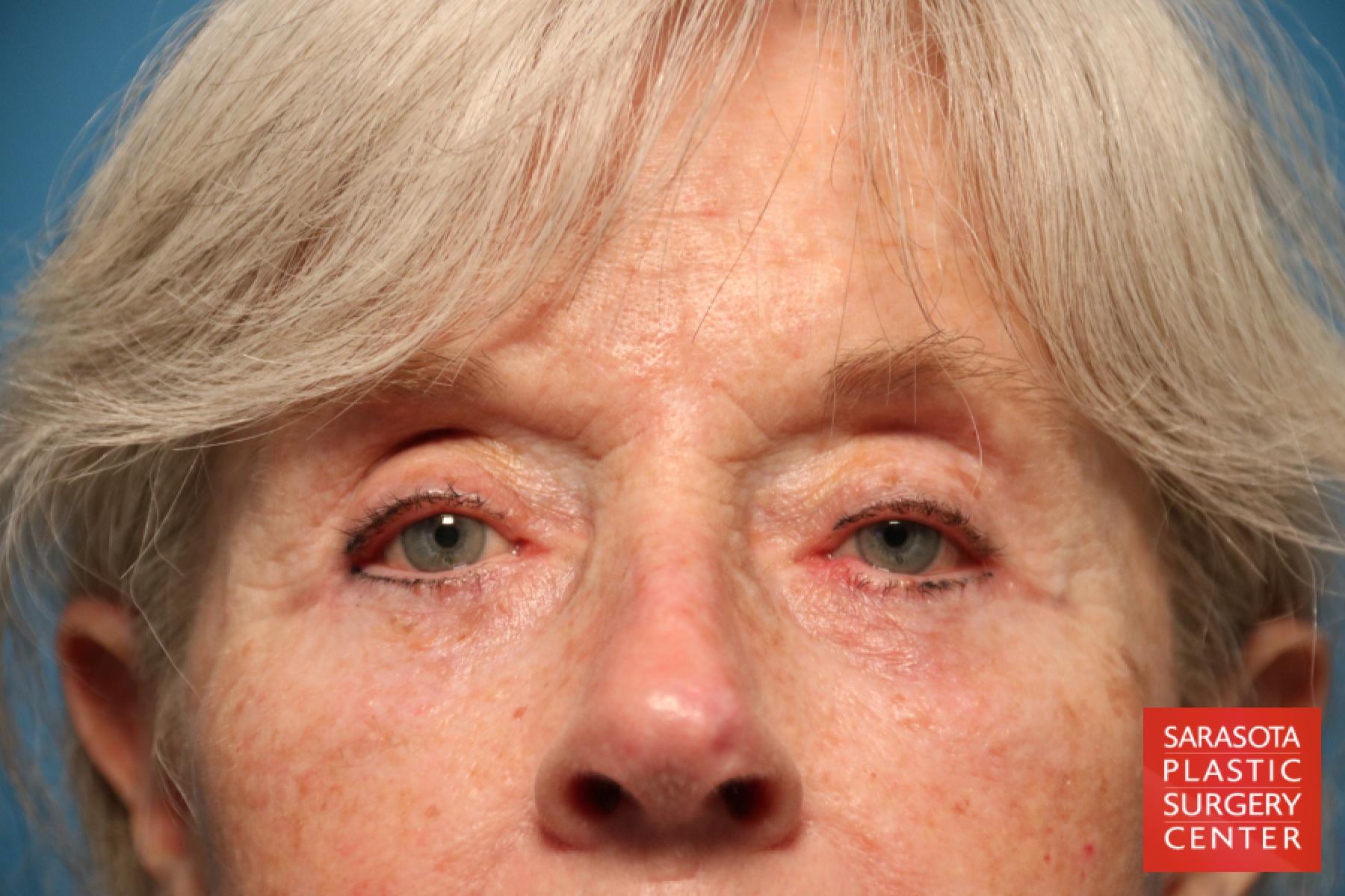 Eyelid Lift: Patient 15 - After 1