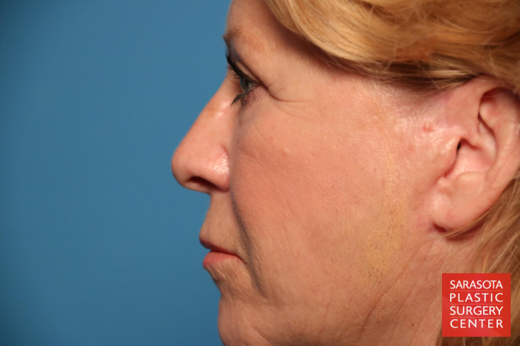 Laser Skin Resurfacing - Face: Patient 10 - After 3