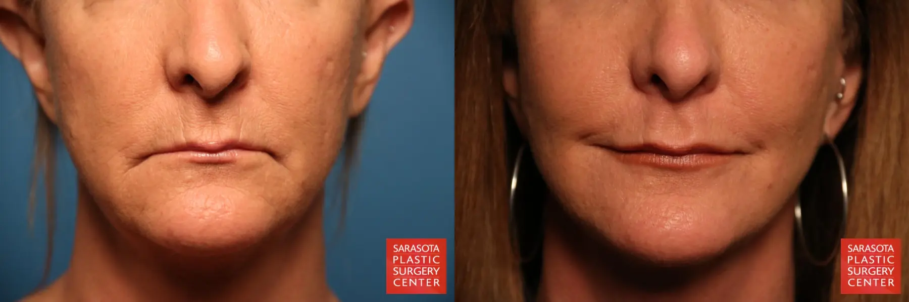 Fillers: Patient 1 - Before and After  