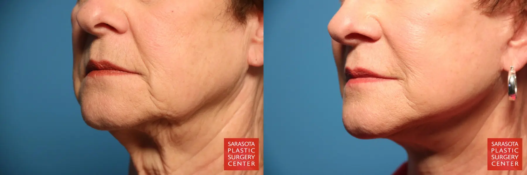 Fillers: Patient 2 - Before and After 3