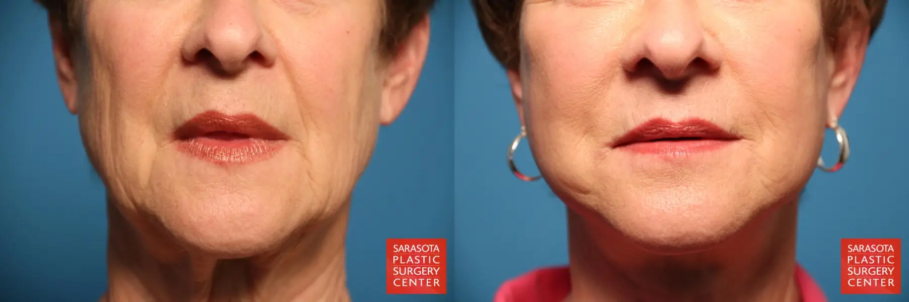 Fillers: Patient 2 - Before and After  