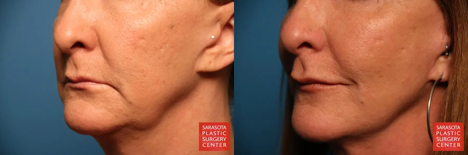 Fillers: Patient 1 - Before and After 2