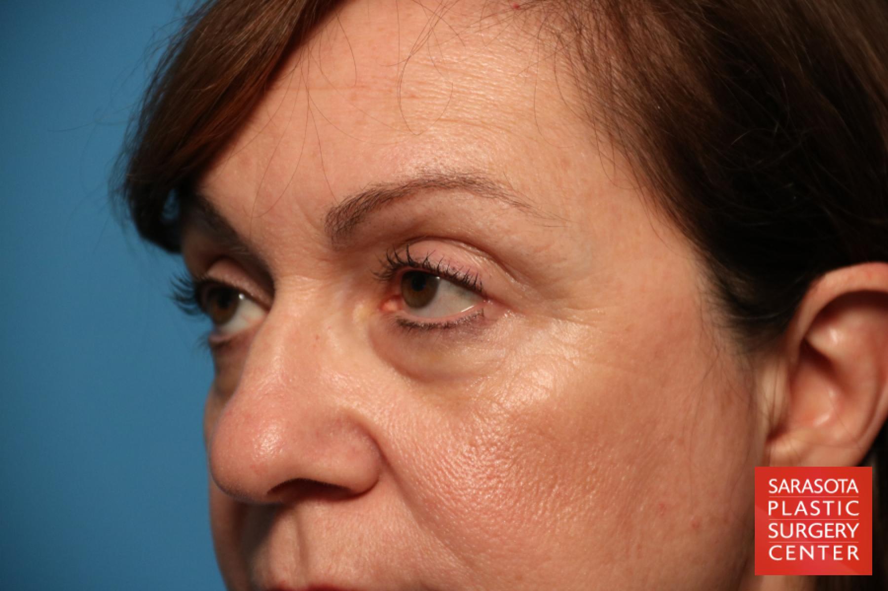 Eyelid Lift: Patient 31 - Before 3