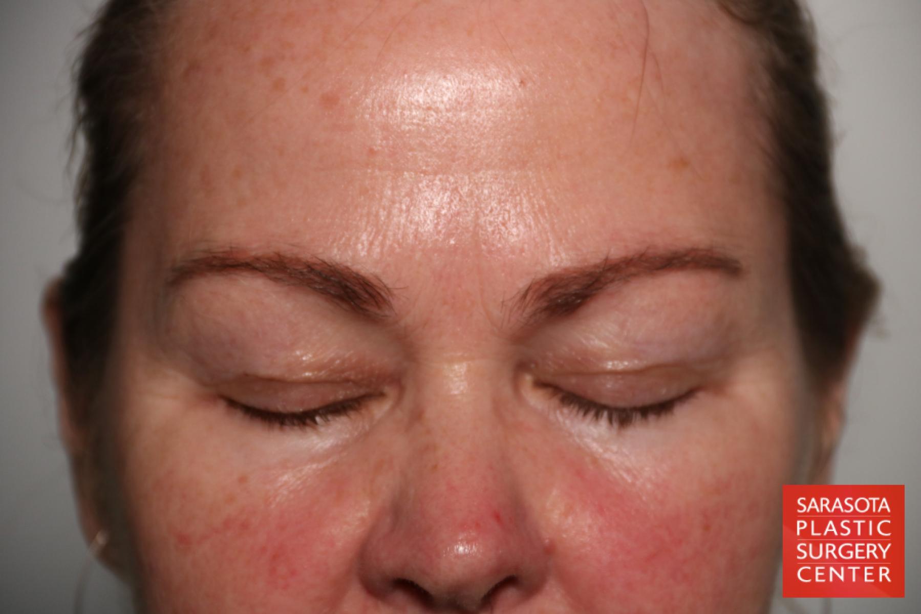 Eyelid Lift: Patient 44 - Before 2