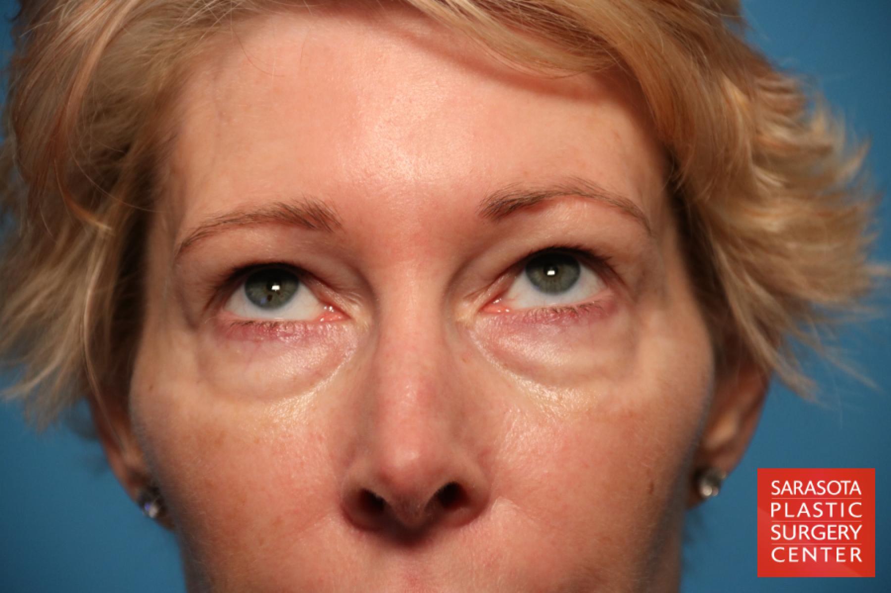 Eyelid Lift: Patient 12 - Before 2