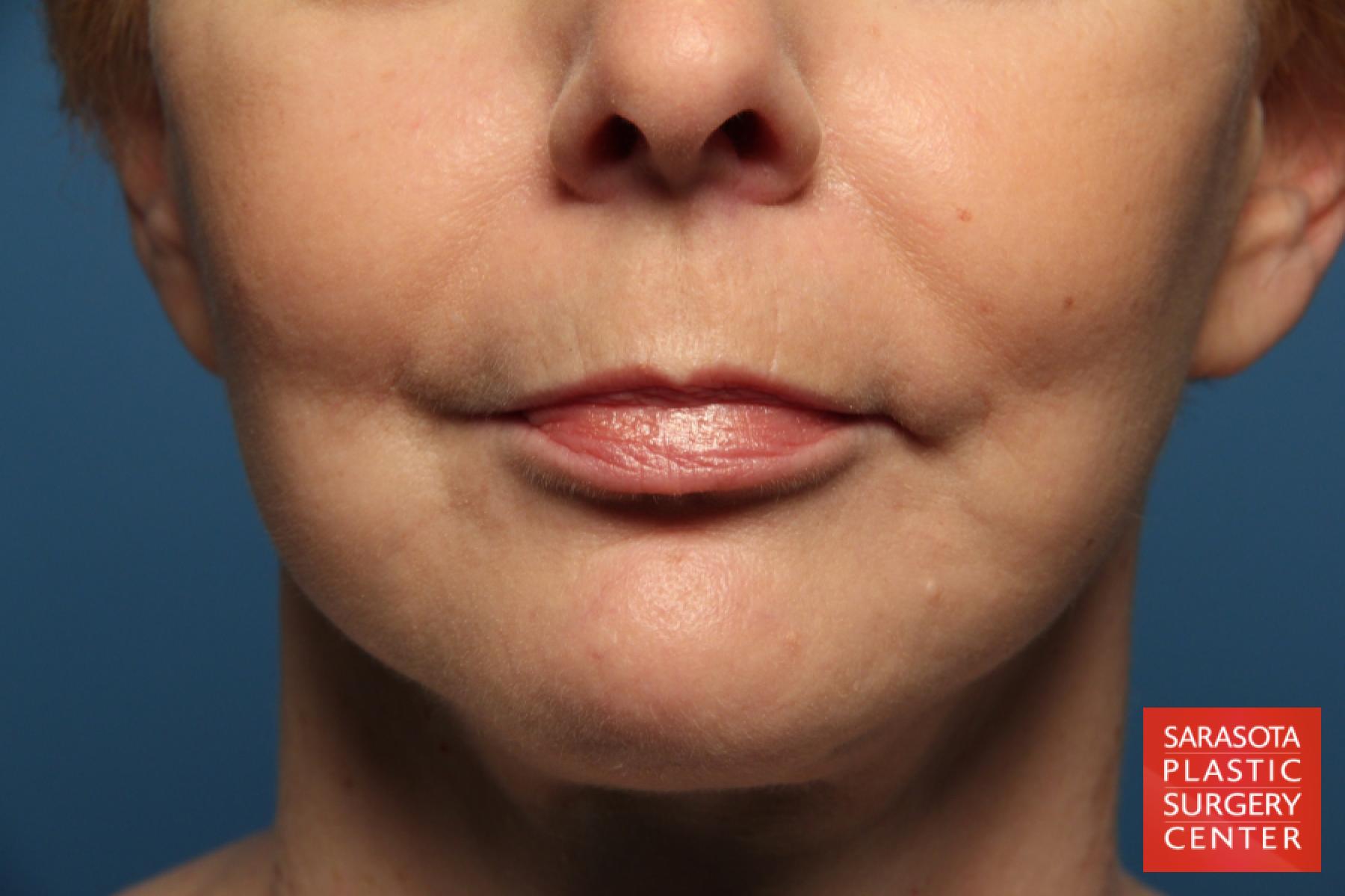 Laser Skin Resurfacing - Face: Patient 5 - Before 