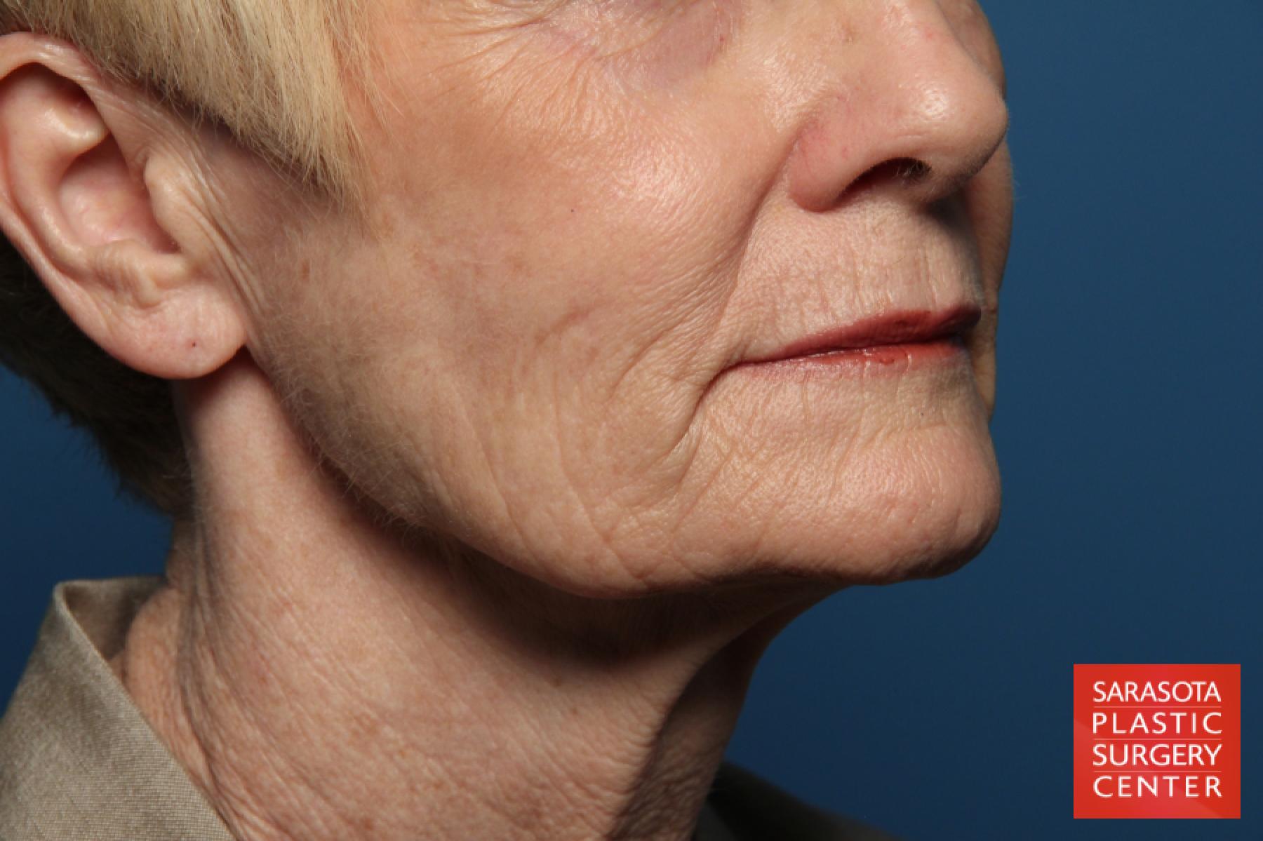 Laser Skin Resurfacing - Face: Patient 15 - Before 4
