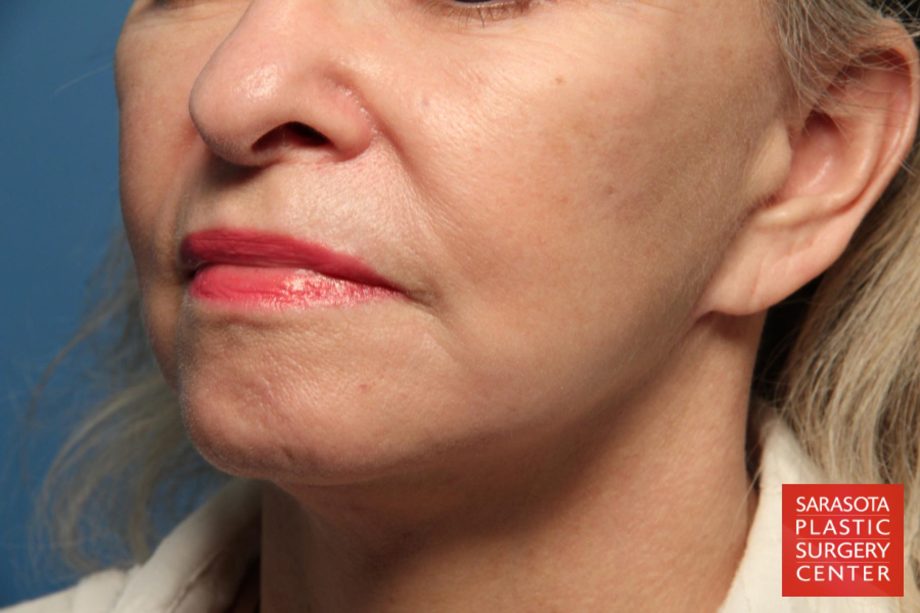Laser Skin Resurfacing - Face: Patient 1 - After 2