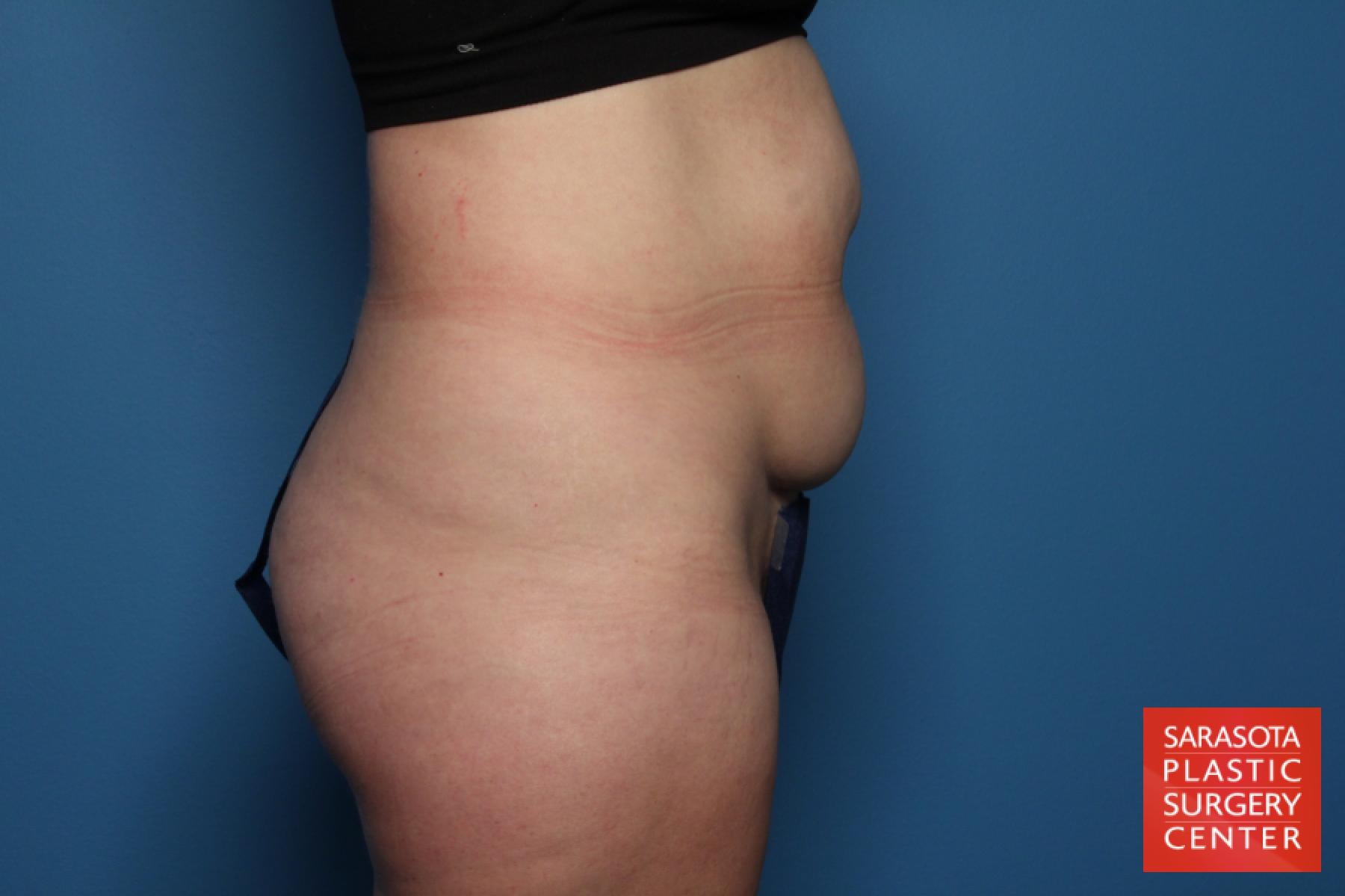Mini Tummy Tuck: Patient 3 - Before and After 3