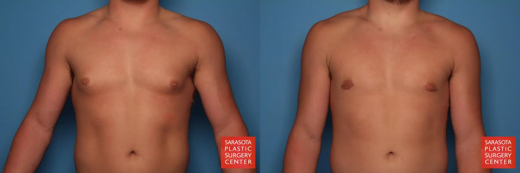 Gynecomastia: Patient 18 - Before and After  