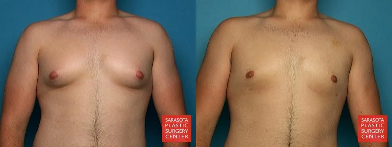 Gynecomastia: Patient 1 - Before and After  