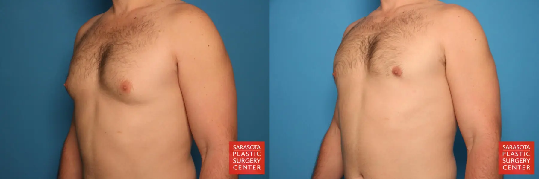 Gynecomastia: Patient 4 - Before and After 2