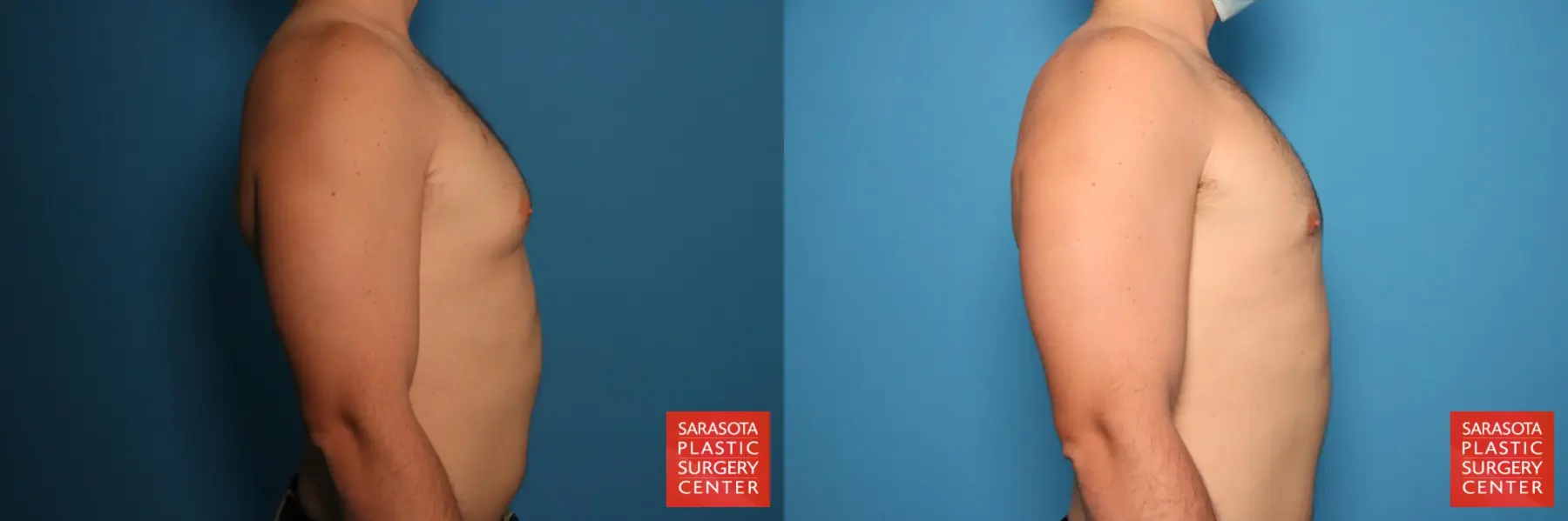 Gynecomastia: Patient 4 - Before and After 5