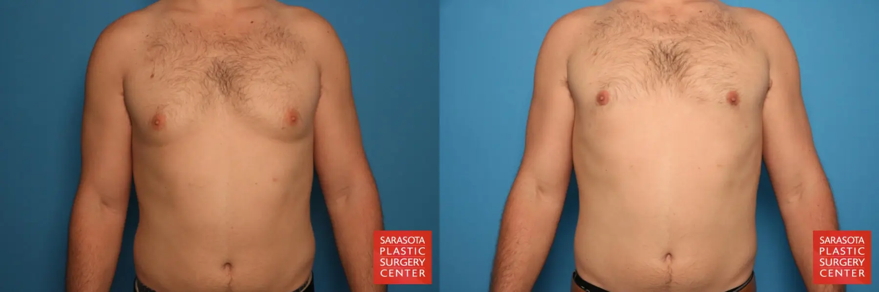 Gynecomastia: Patient 4 - Before and After  