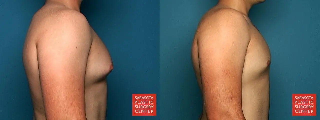 Gynecomastia: Patient 1 - Before and After 5