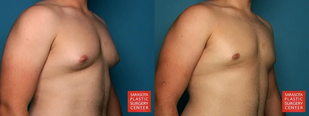 Gynecomastia: Patient 1 - Before and After 4