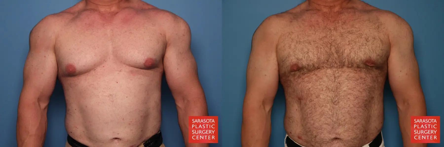 Gynecomastia: Patient 2 - Before and After  