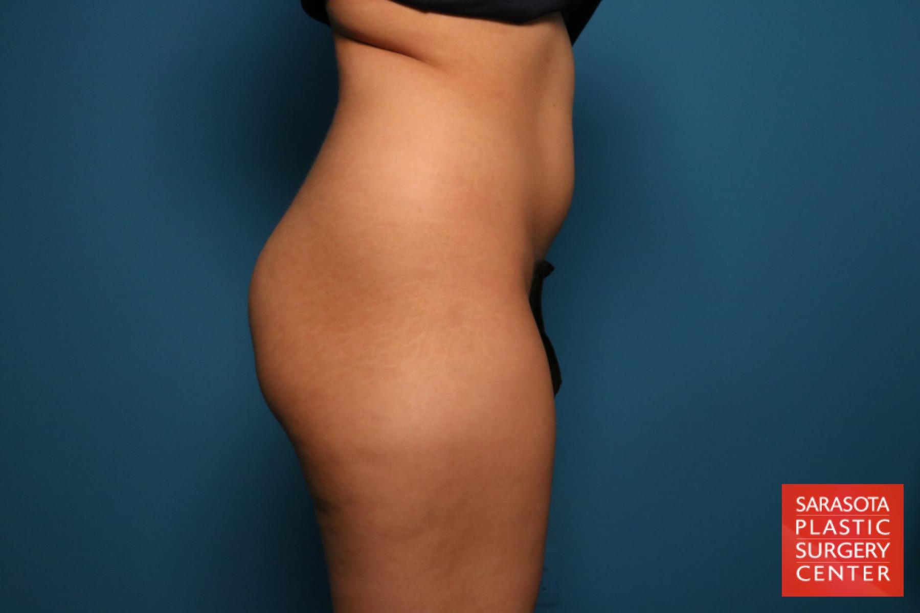 Liposuction: Patient 15 - Before and After 6
