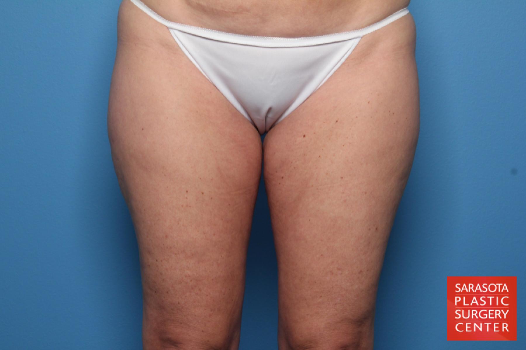 Liposuction: Patient 11 - Before 1