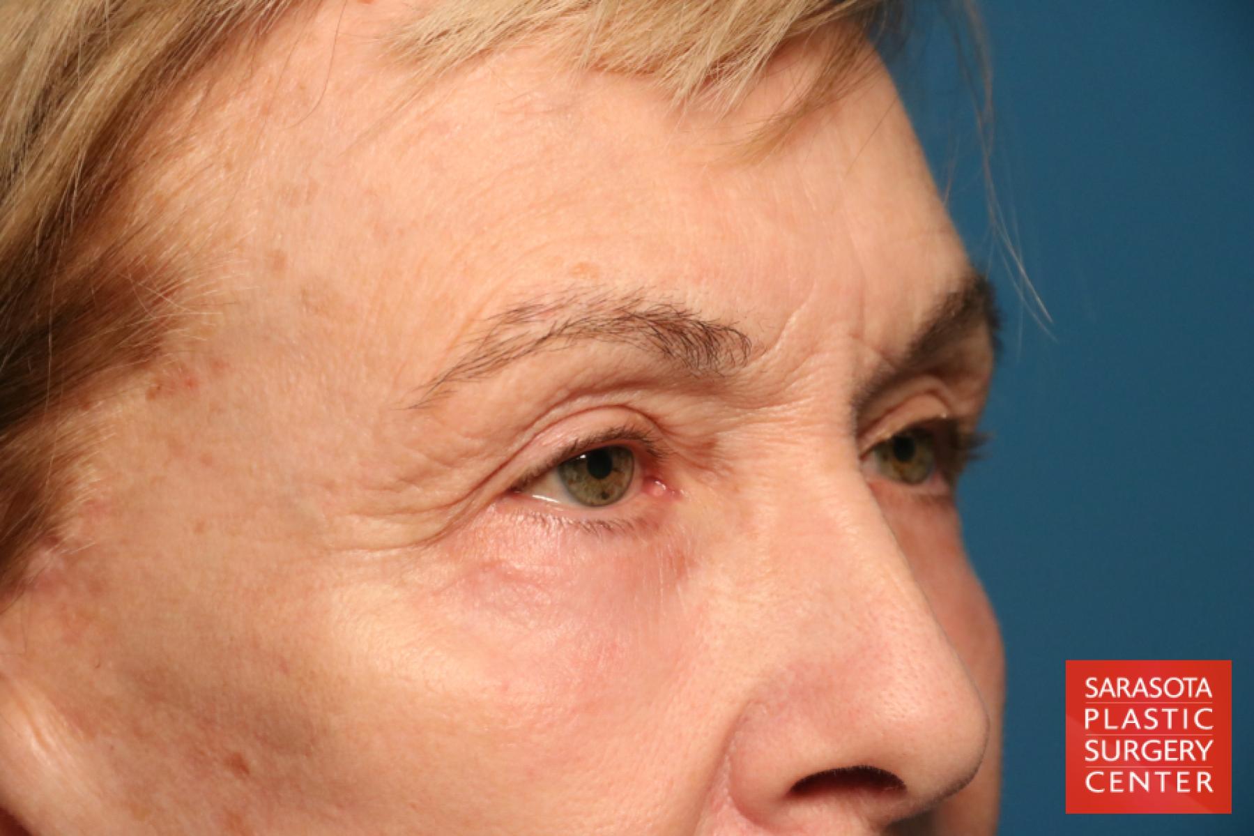 Eyelid Lift: Patient 43 - After 3