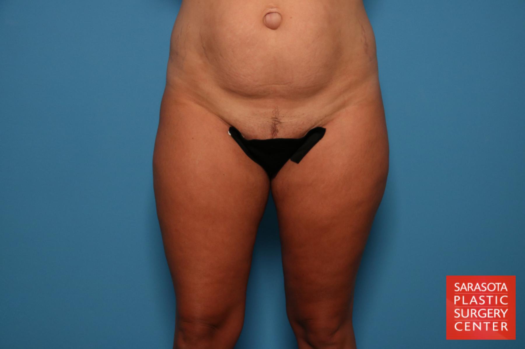 Liposuction: Patient 7 - Before 2