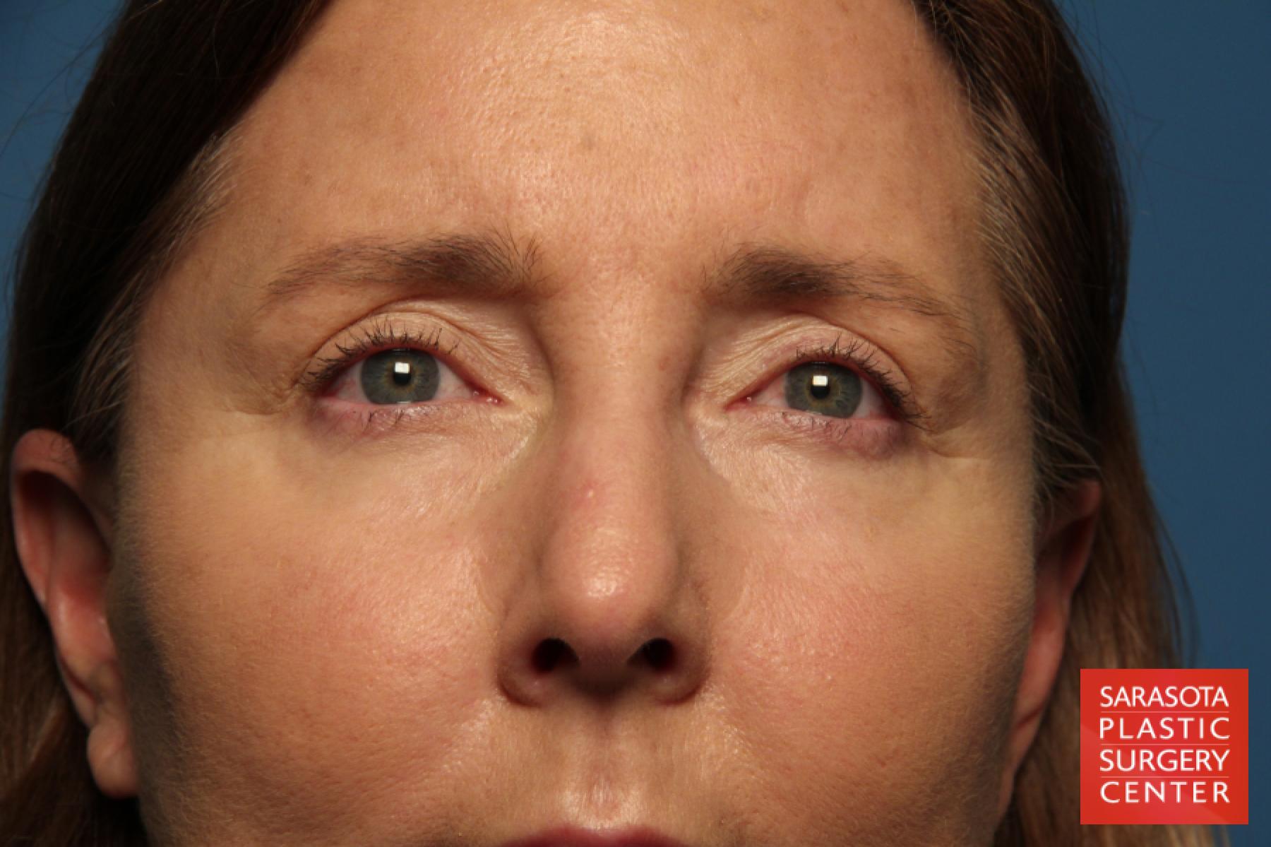 Eyelid Lift: Patient 35 - After 1
